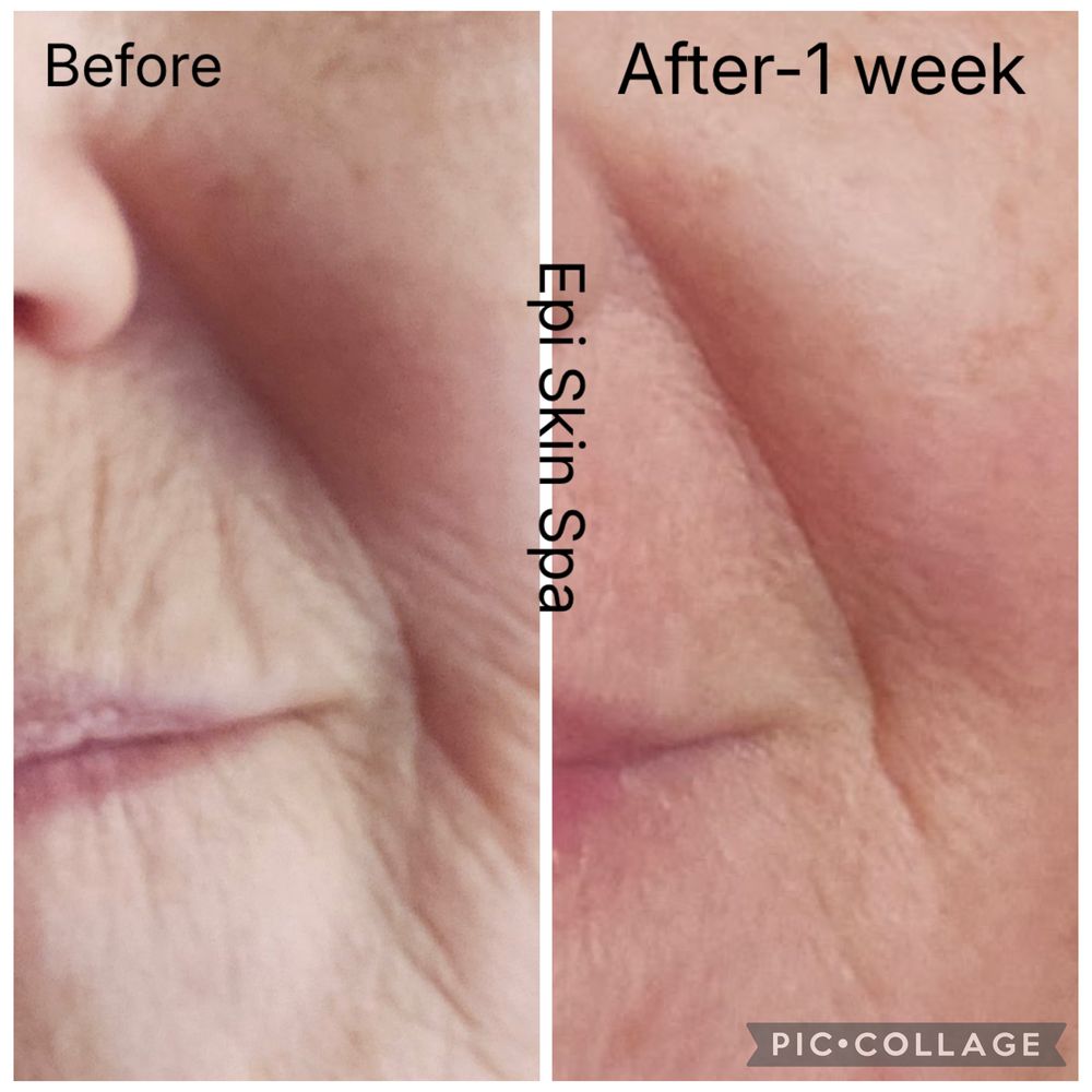 Before and one week after: lines above the lip look softer