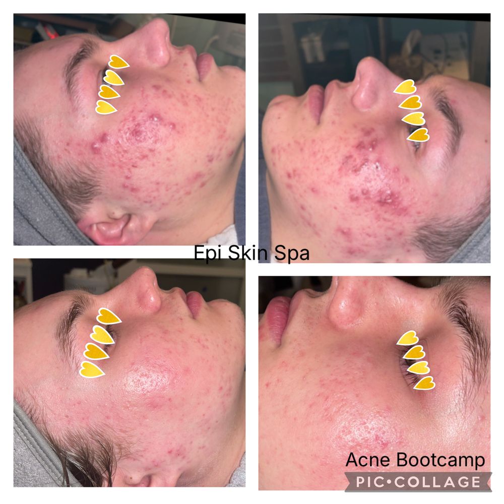 Acne Boot Camp client, before and after: four side views of the cheeks showing fewer breakouts