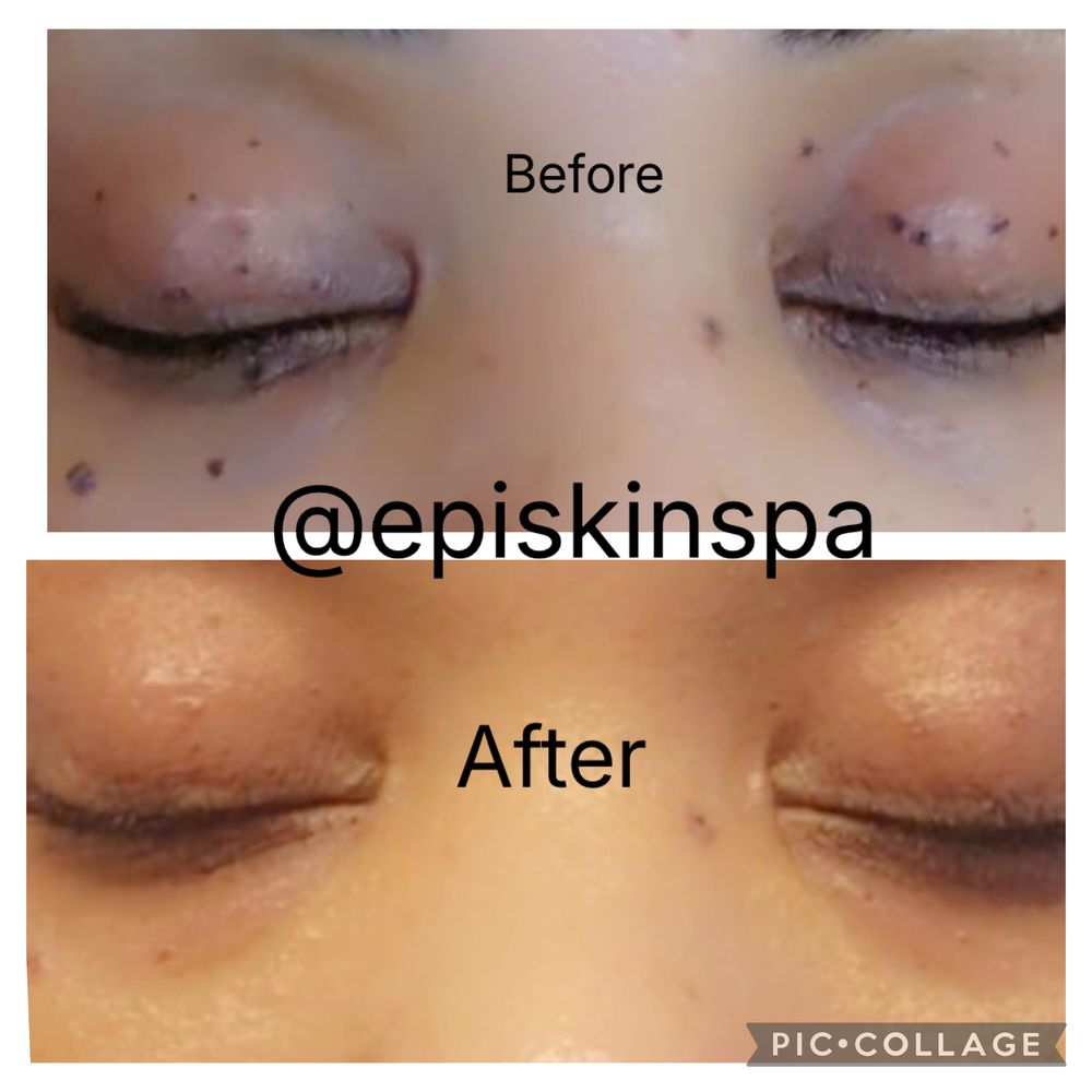 Before and after: small dark spots around the eyes cleared